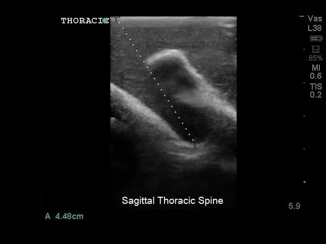 Lumbar Puncture and Spinal Epidural Training Model